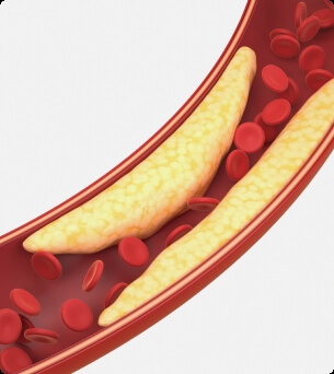 Vernauwde bloedbaan te hoog cholesterol